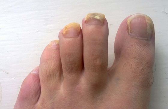 vad är nagelsvamp vad är nagelsvamp